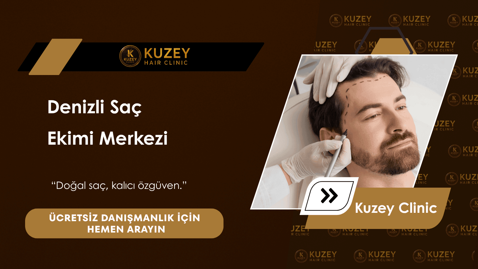 Denizli saç ekimi öncesi saç analizi ve greft planlaması