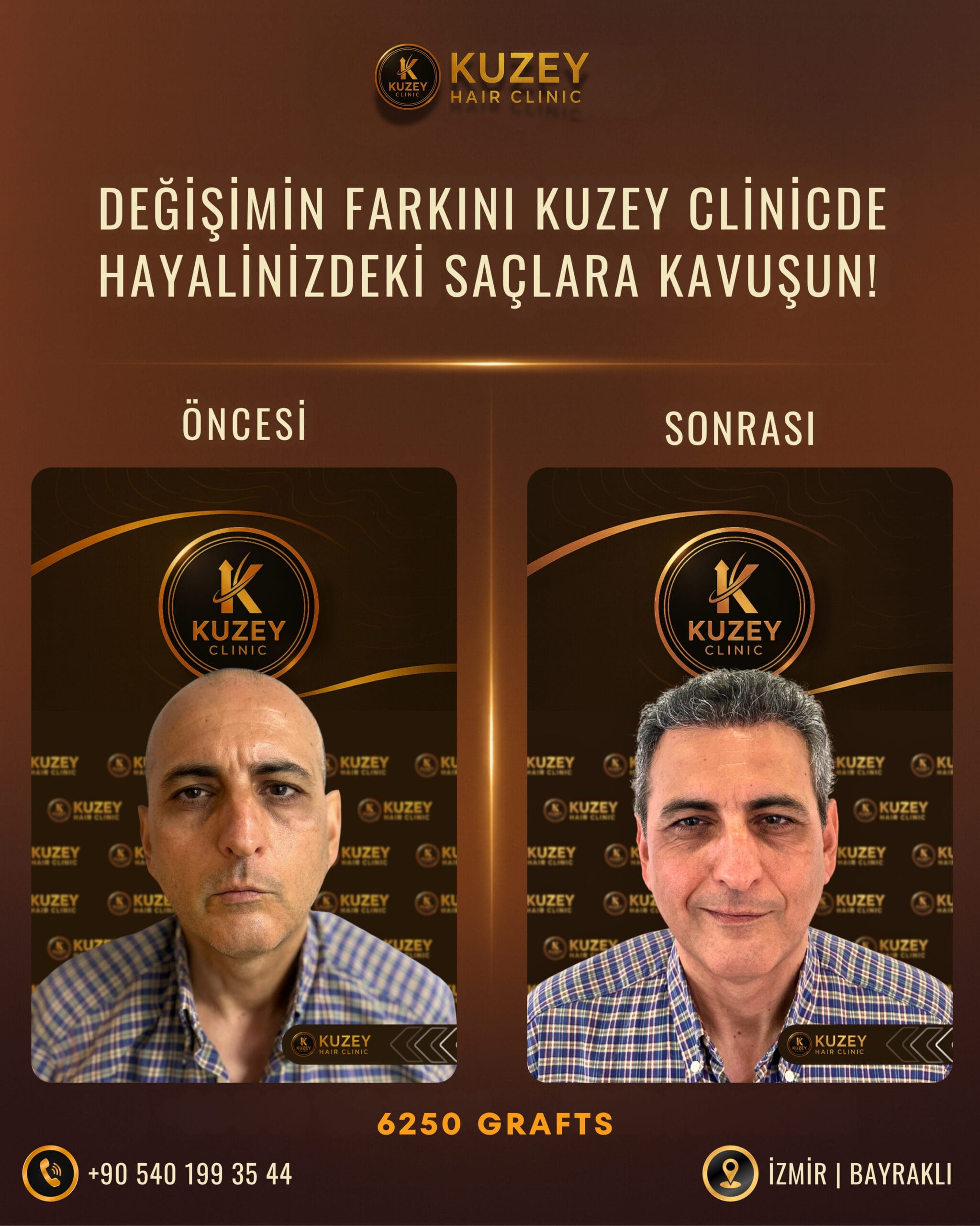 İzmir saç ekimi öncesi sonrası Kuzey Clinic