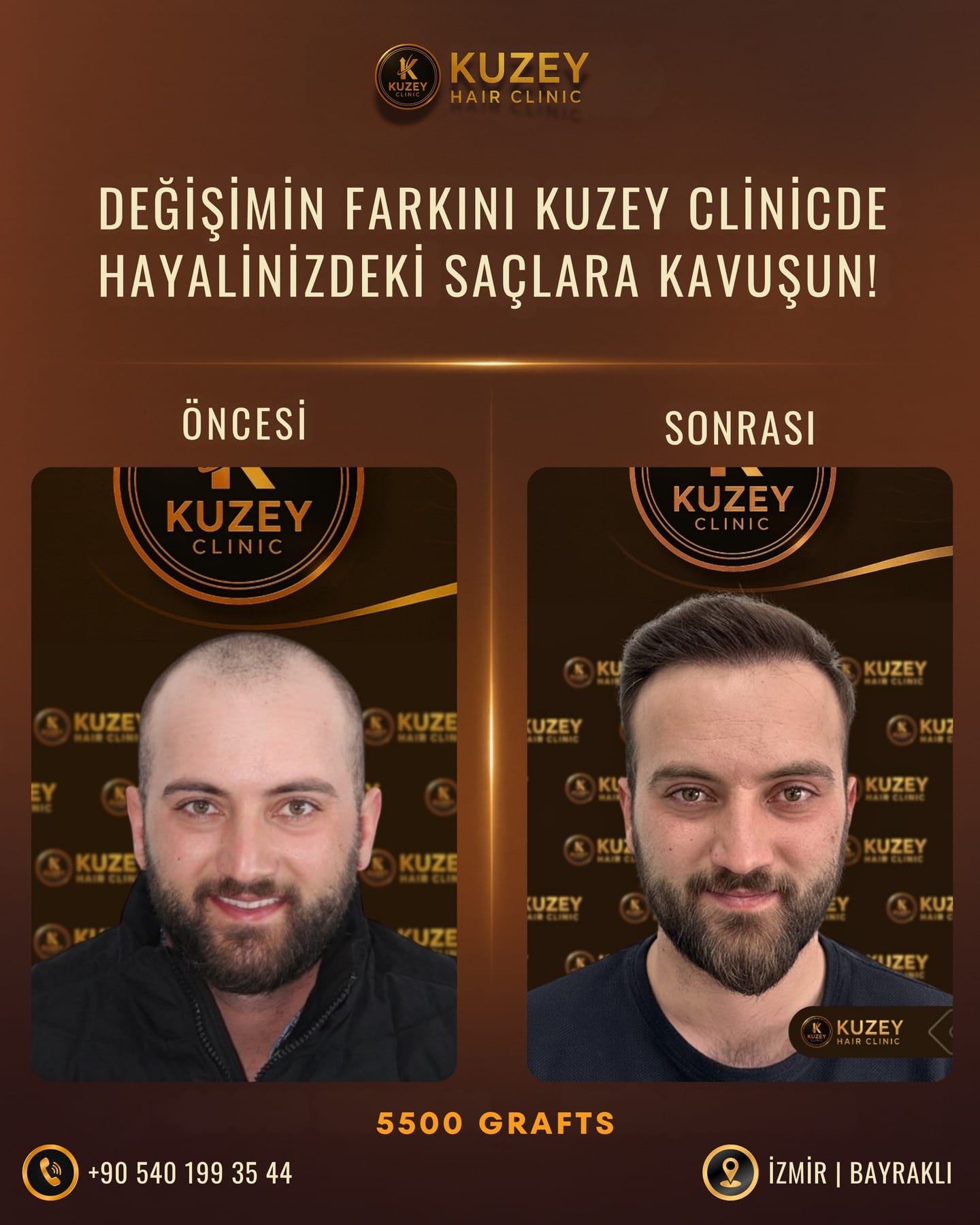 Kuzey Clinic saç ekimi öncesi sonrası sonucu