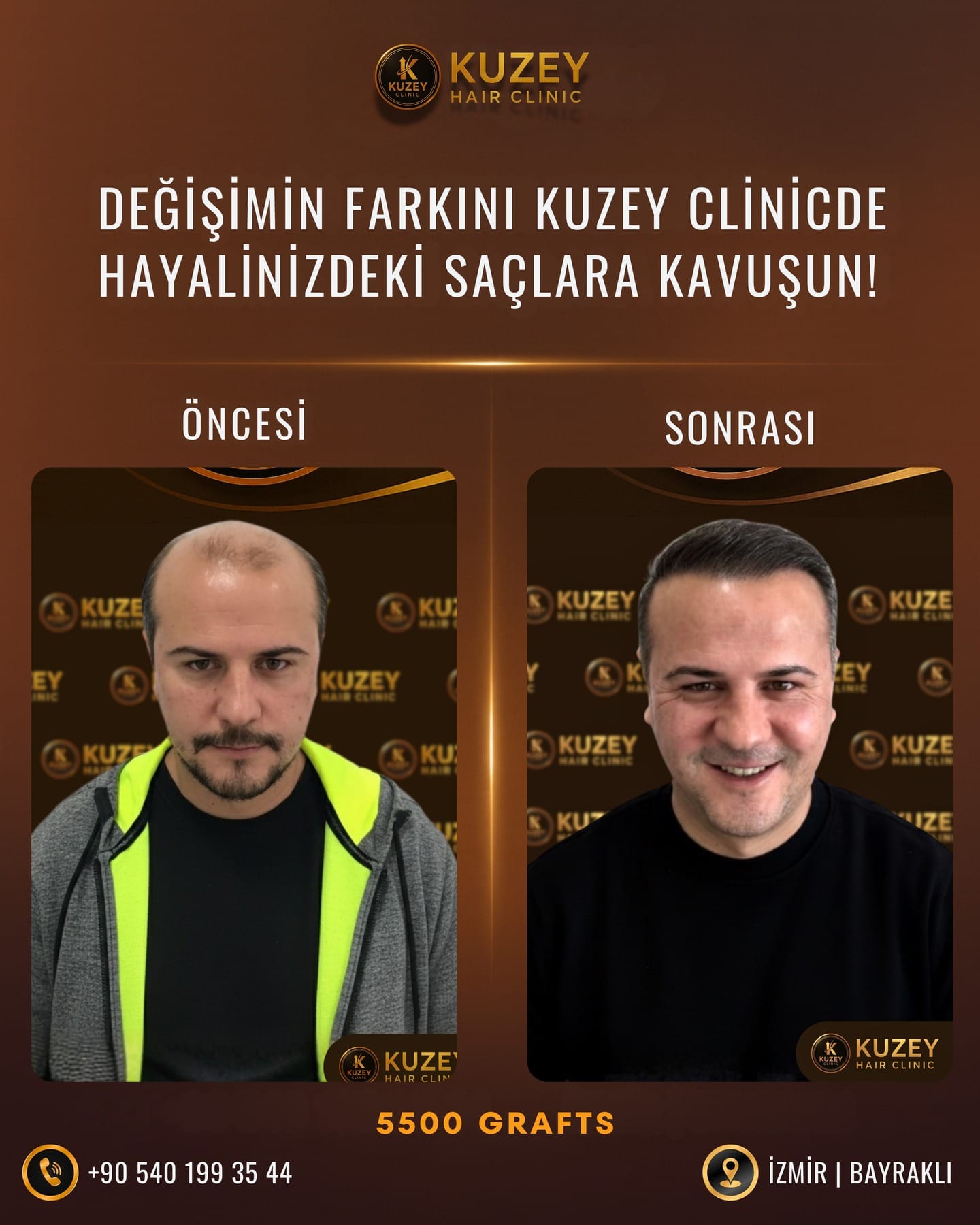 Kuzey Clinic İzmir saç ekimi sonucu