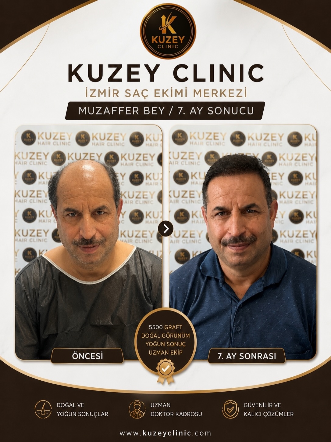 Kuzey Clinic gerçek saç ekimi öncesi sonrası sonucu
