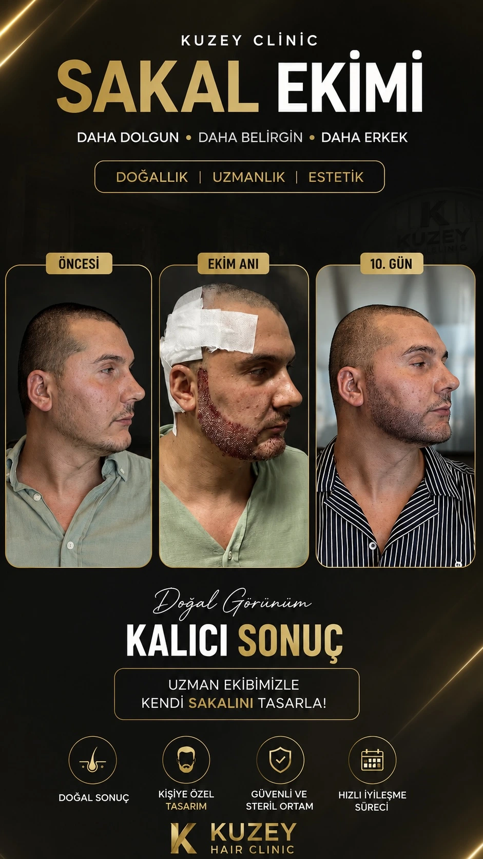 İzmir sakal ekimi Kuzey Clinic