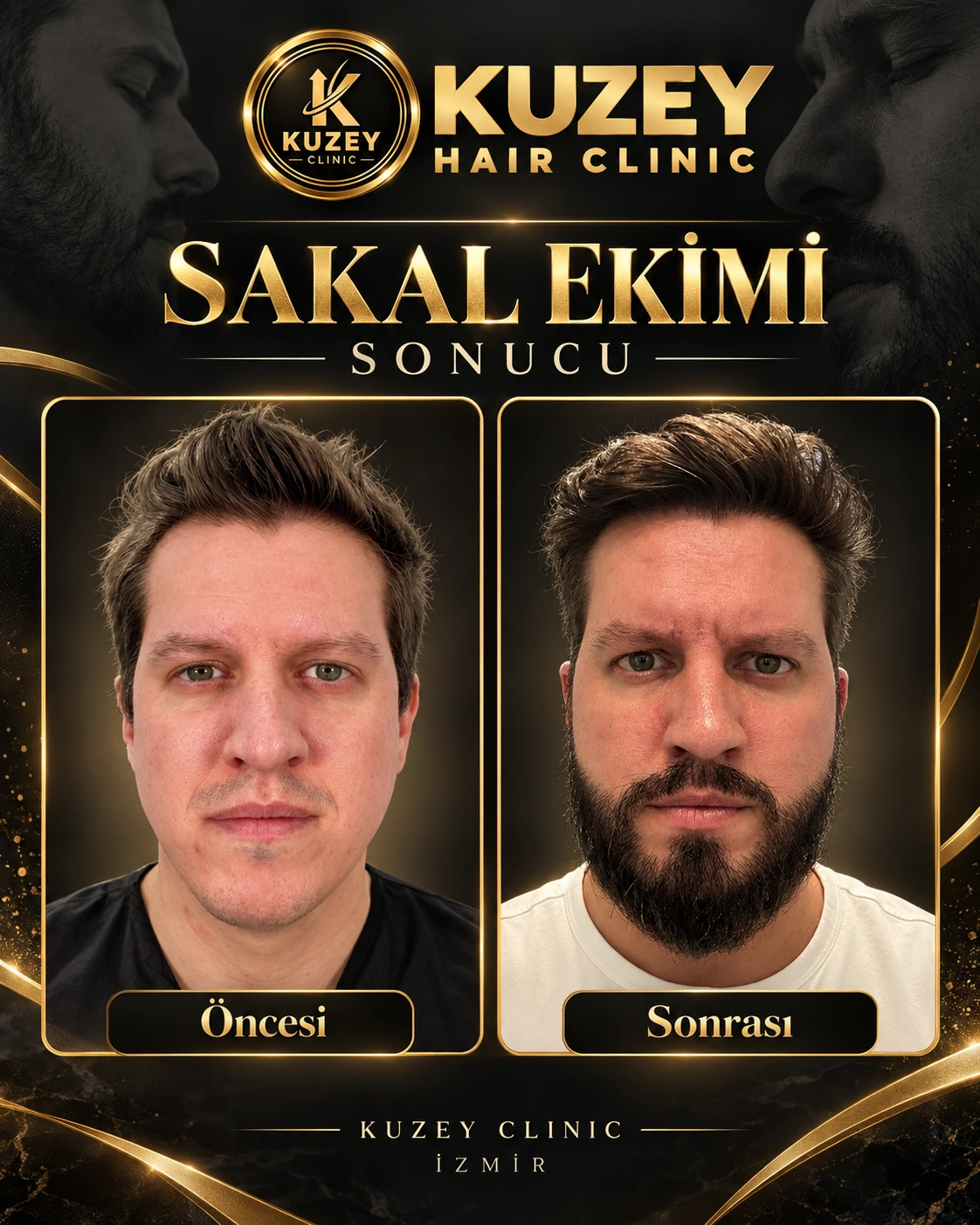 Kuzey Clinic sakal ekimi sonucu 1