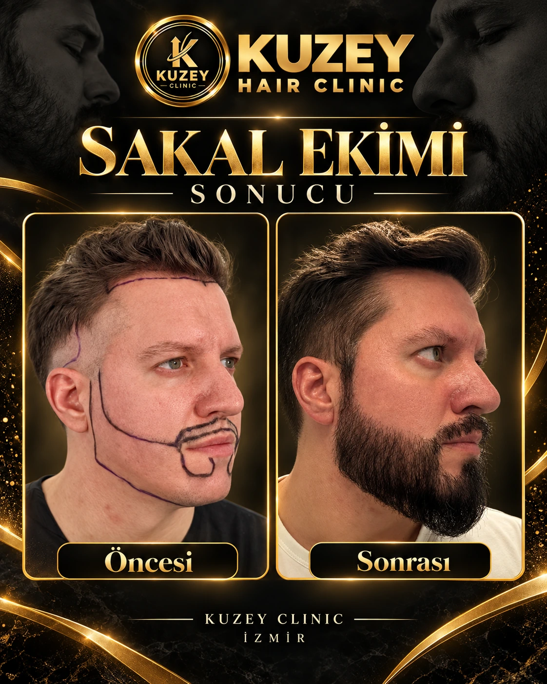Kuzey Clinic sakal ekimi sonucu 2